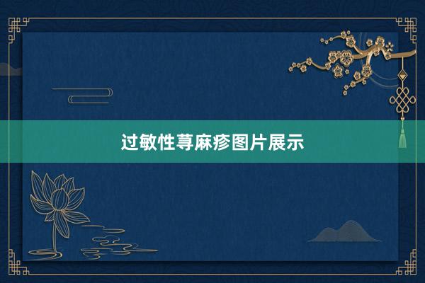 过敏性荨麻疹图片展示